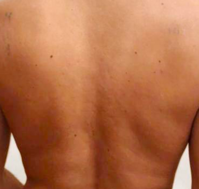 Back without the tattoo following on from Laser Removal