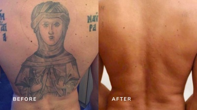 Black Tattoo on back that has been removed with a laser