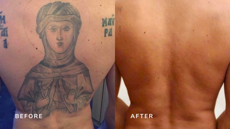 Tattoo Removal in London Before and After