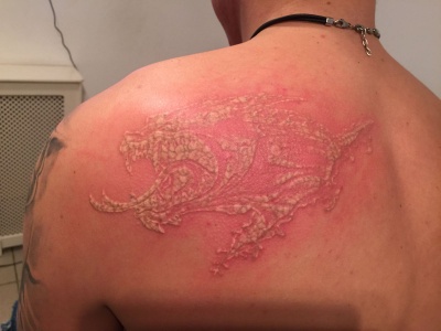 Dragon Tattoo being removed with a laser