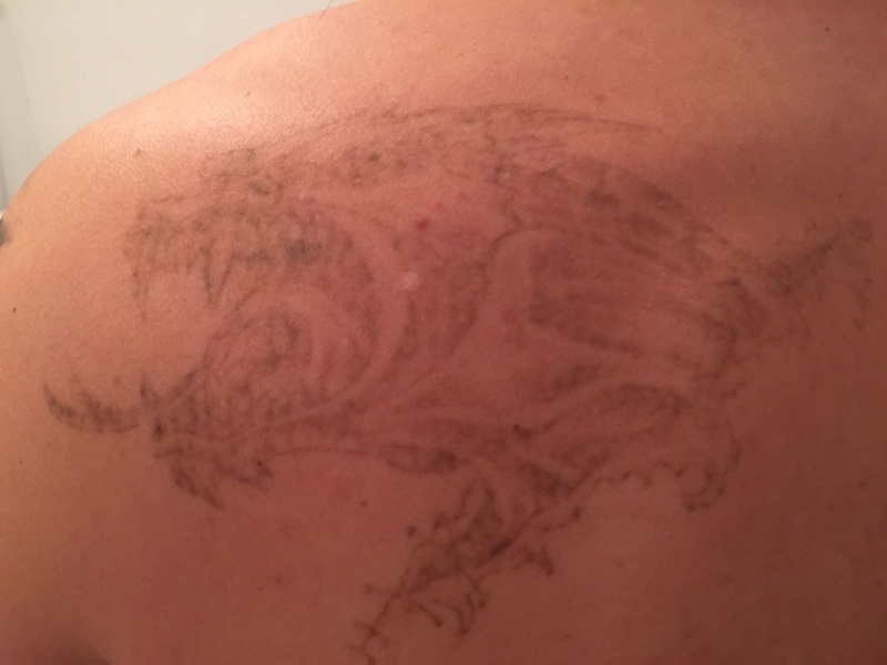 dragon tattoo removal