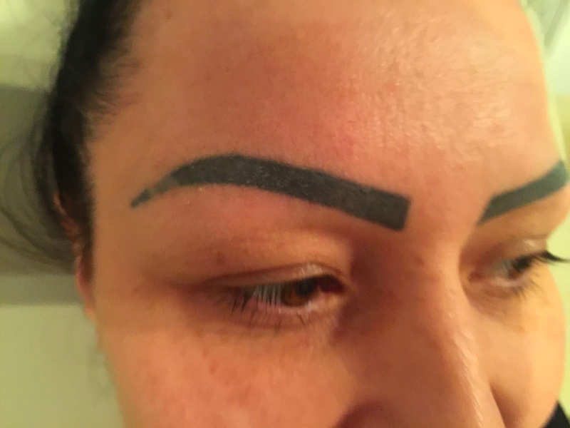 Laser Tattoo Removal of eyebrows. Dark eyebrows on face