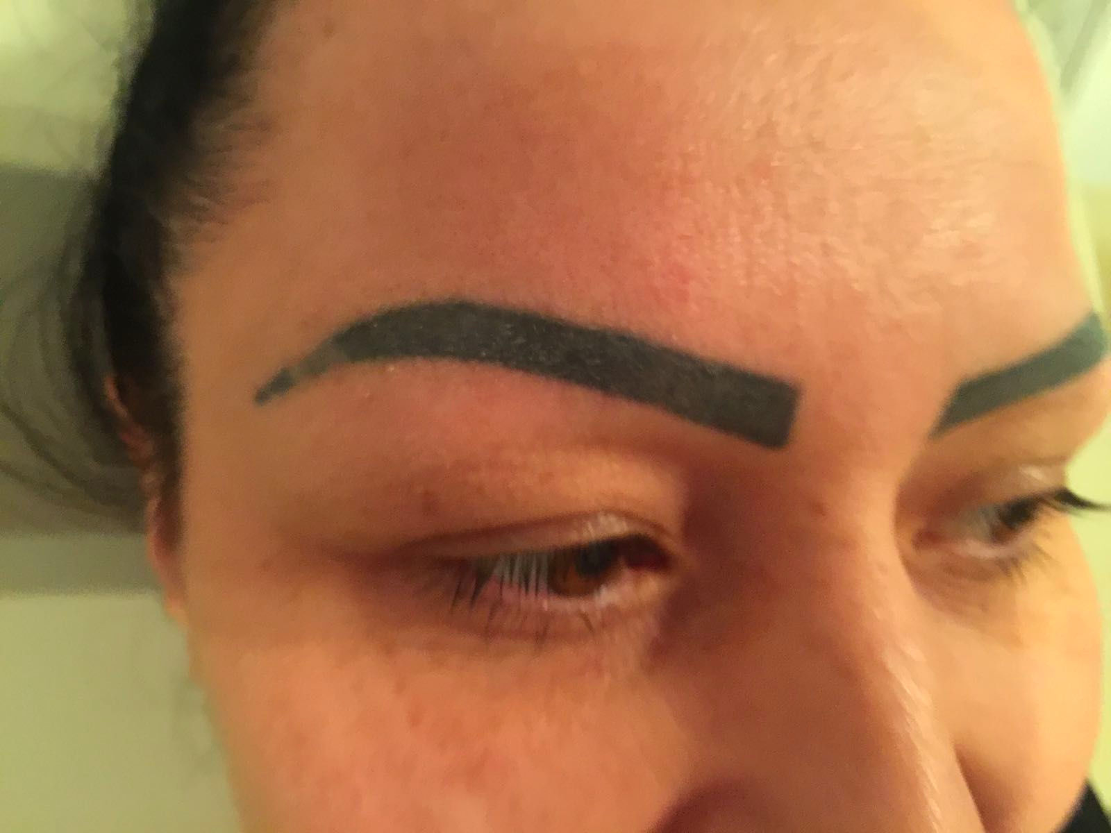 Eyebrow Tattoo Removal  Laser Remedy Skin Solutions